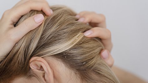 Szeborreás dermatitisz – Hogyan lehet felismerni és kezelni?