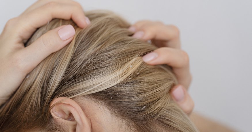 Szeborreás dermatitisz – Hogyan lehet felismerni és kezelni? - hero