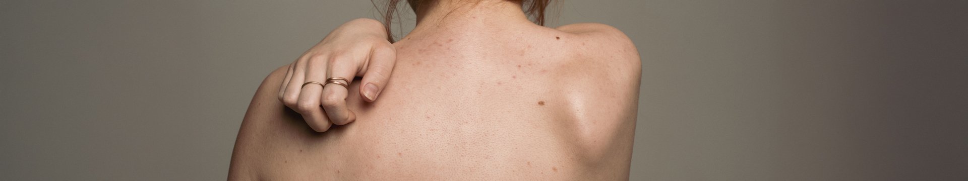 Mit kezdjünk a barna foltokkal a bőrön? - header