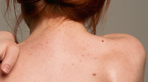 Mit kezdjünk a barna foltokkal a bőrön?