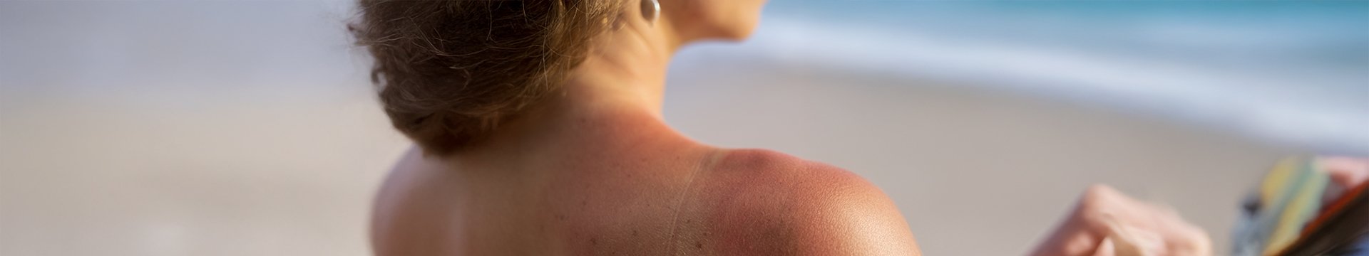 Hogyan lehet megszabadulni a napkiütésektől és a foltoktól? header