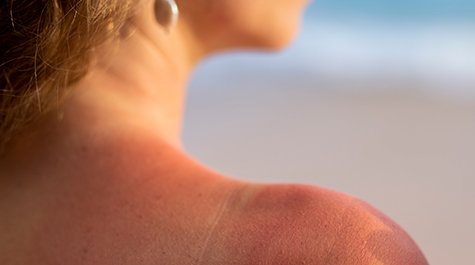 Hogyan lehet megszabadulni a napkiütésektől és a foltoktól?