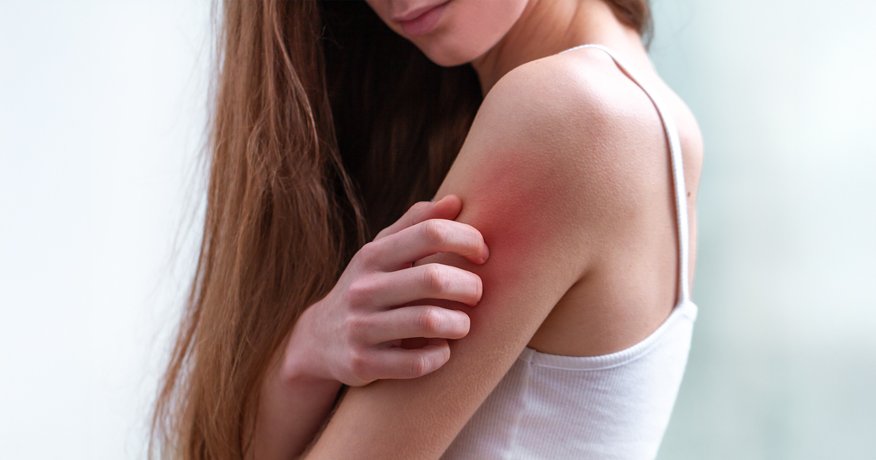 Melyek az ekcéma leggyakoribb típusai, és hogyan lehet felismerni őket? Hero