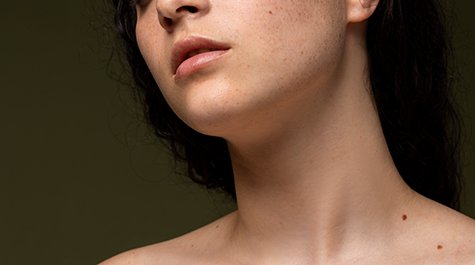 Barna foltok a bőrön és hogyan lehet megszabadulni tőlük