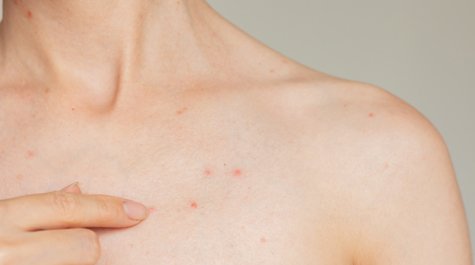 Hogyan kezelhetők a pattanások a háton, a dekoltázson és a testen?