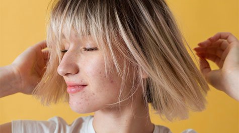 Arcbőr és akné pubertáskorban – Hogyan lehet megszabadulni a pattanásoktól?