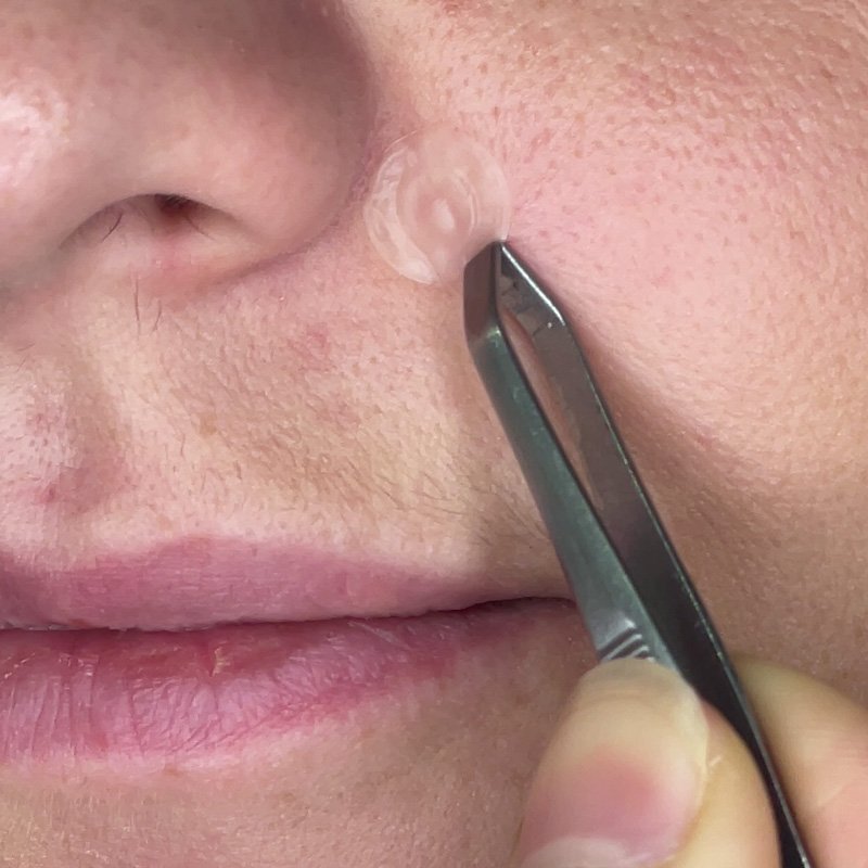 Pimple Patches Detail