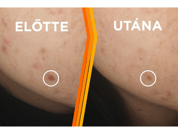 Vitamin C Elotte - Utána